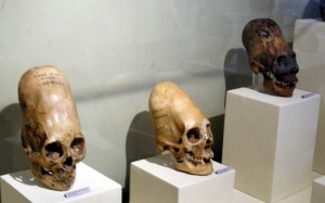 craniile deformate